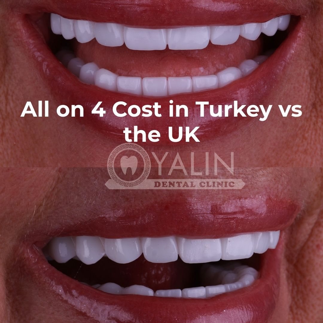 All on 4 cost in Turkey vs the UK, Antalya