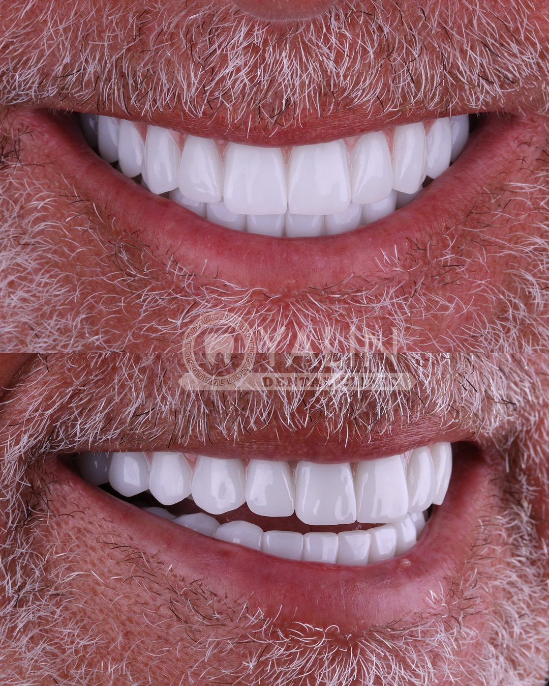 Full arch of fixed teeth after All on 6 treatment at Yalın Dental Clinic, Antalya