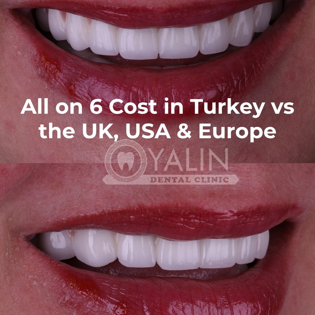 All on 6 cost in Turkey vs the UK, USA and Europe, Antalya
