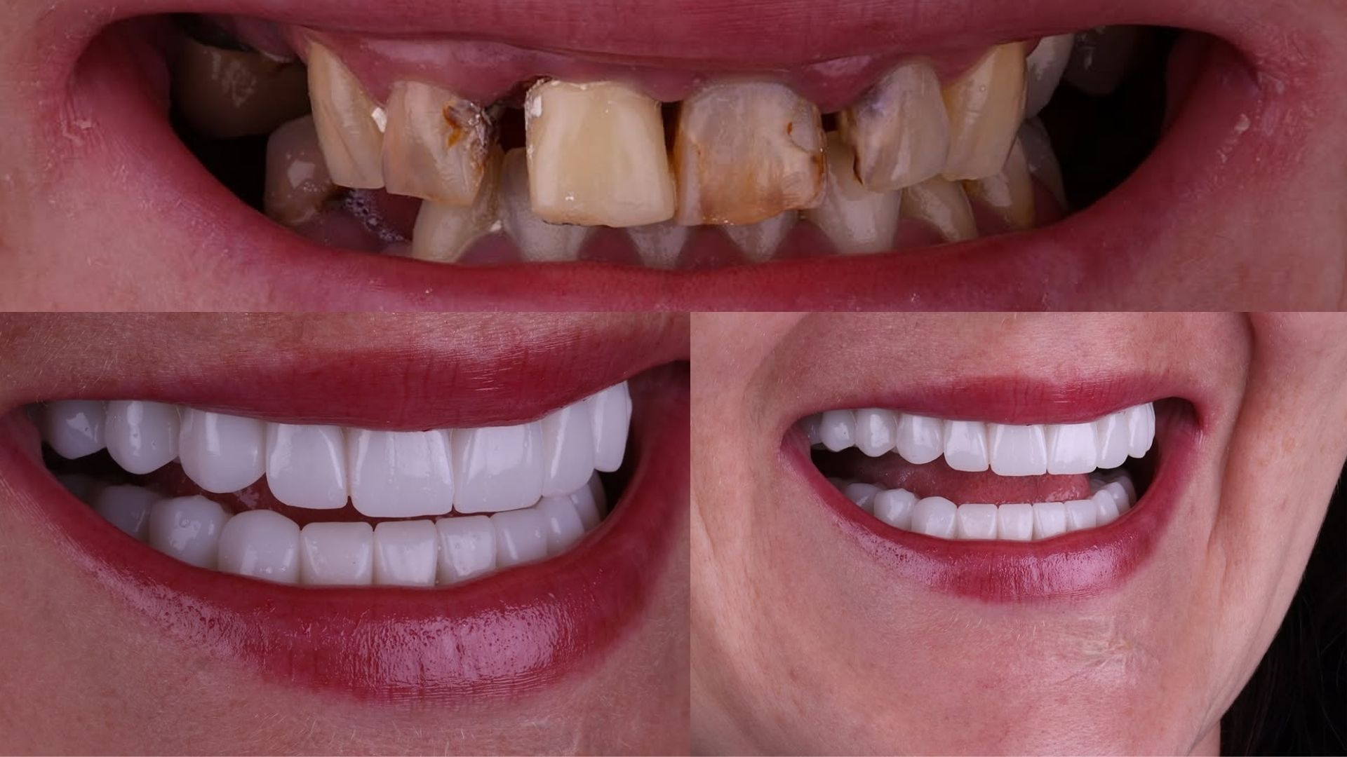 Dental Implants Before and After in Turkey, Antalya