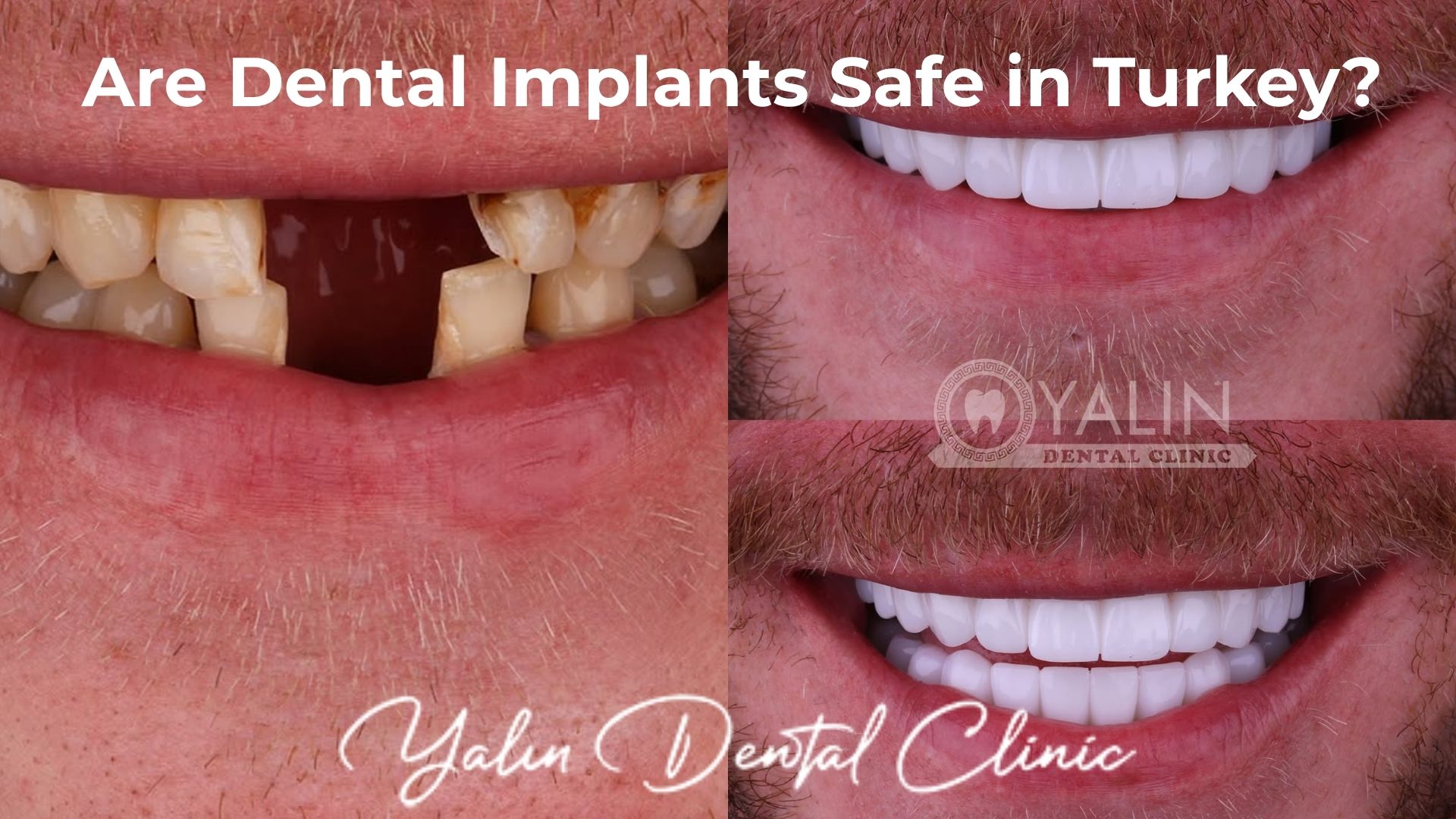 Are Dental Implants in Turkey Safe?