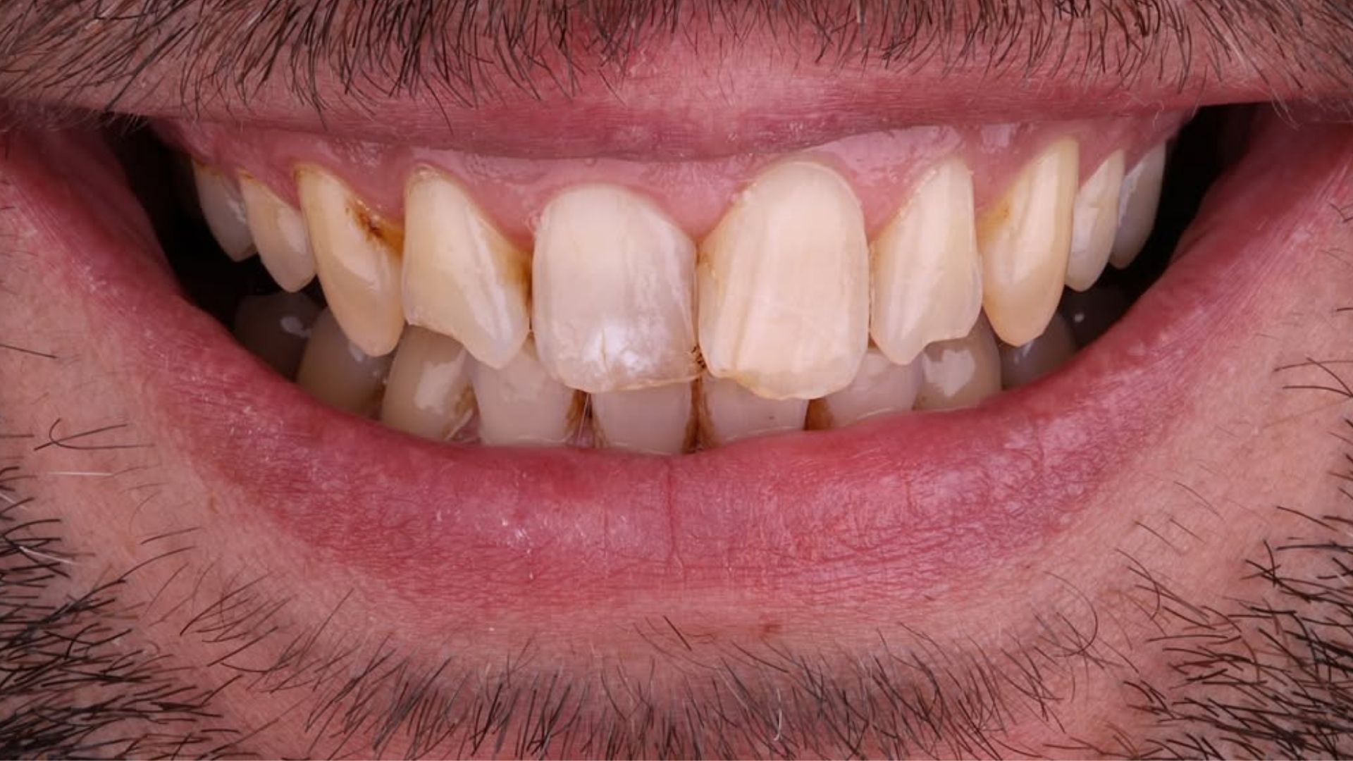 Dental Veneers Before and After-1