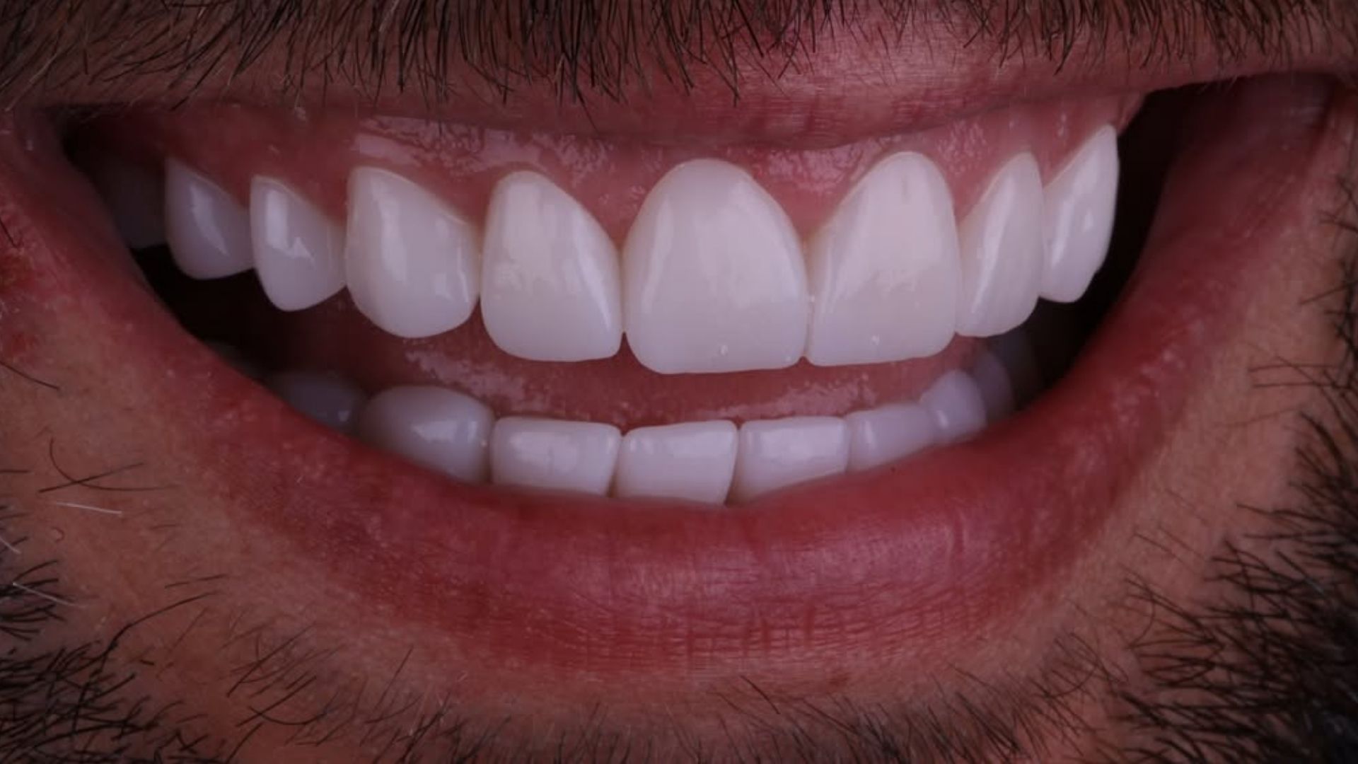 Dental Veneers Before and After-2