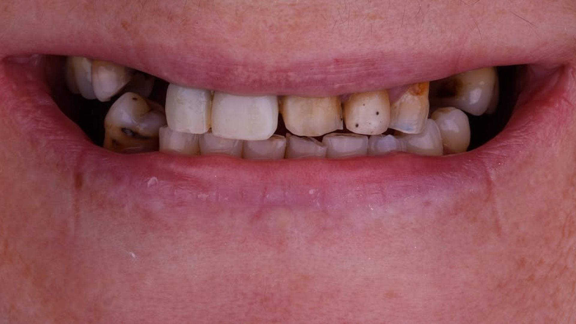 Dental Veneers Before and After-3
