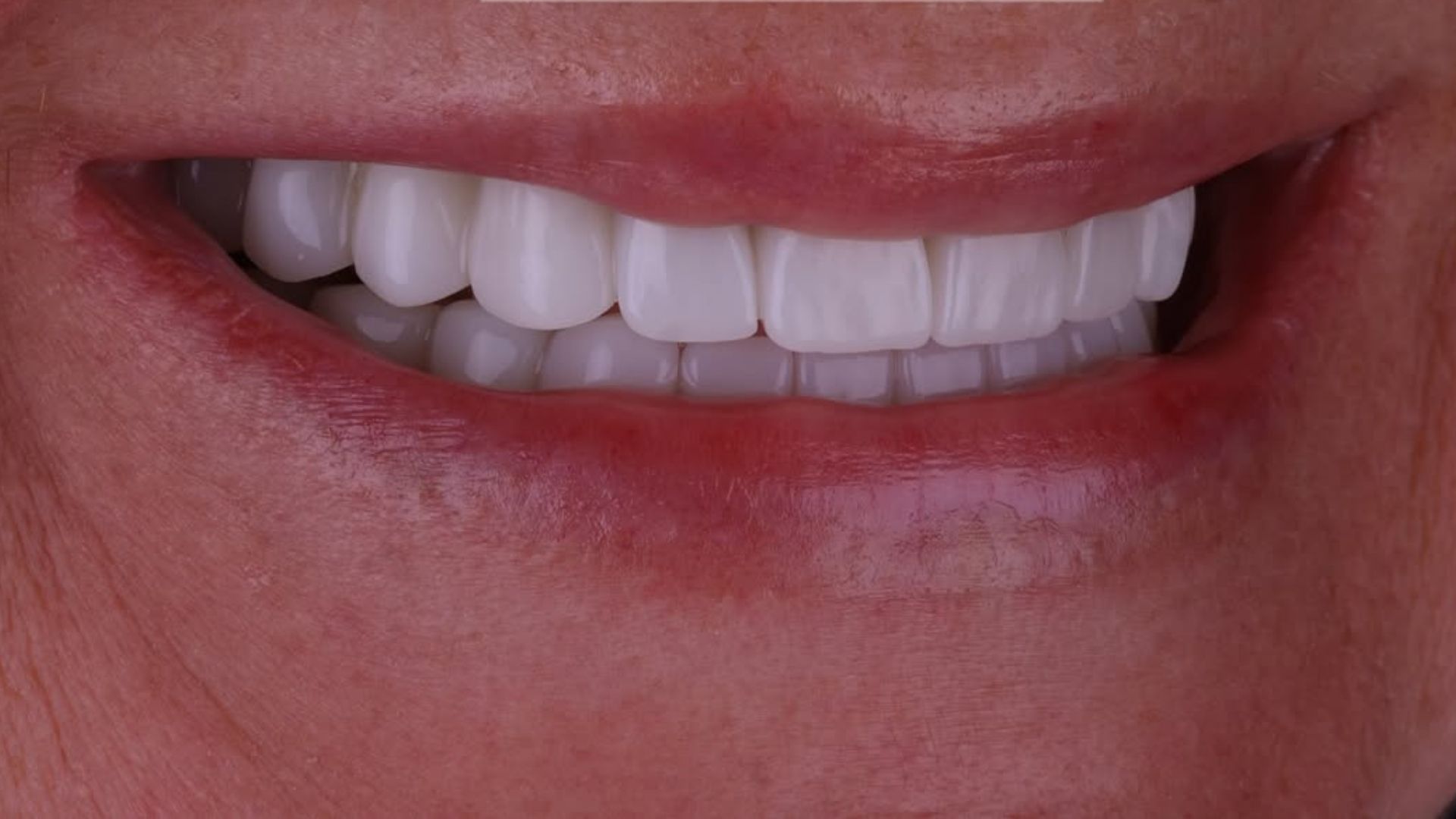 Dental Veneers Before and After-4