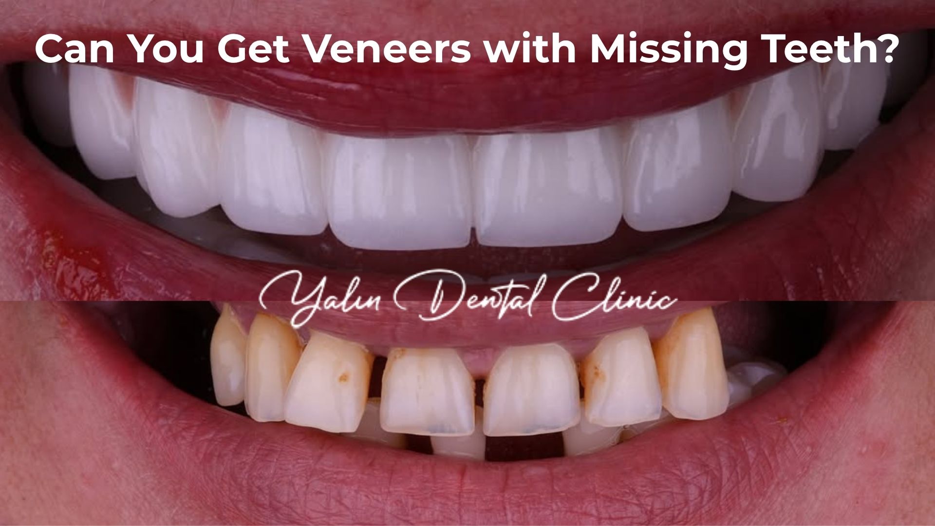 Can You Get Veneers with Missing Teeth?