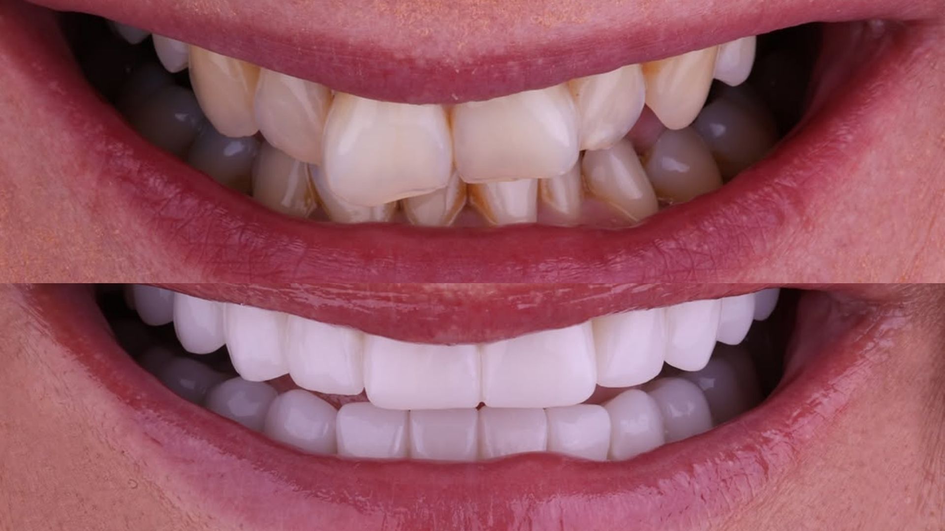 Dental Crowns Before and After in Antalya, Turkey