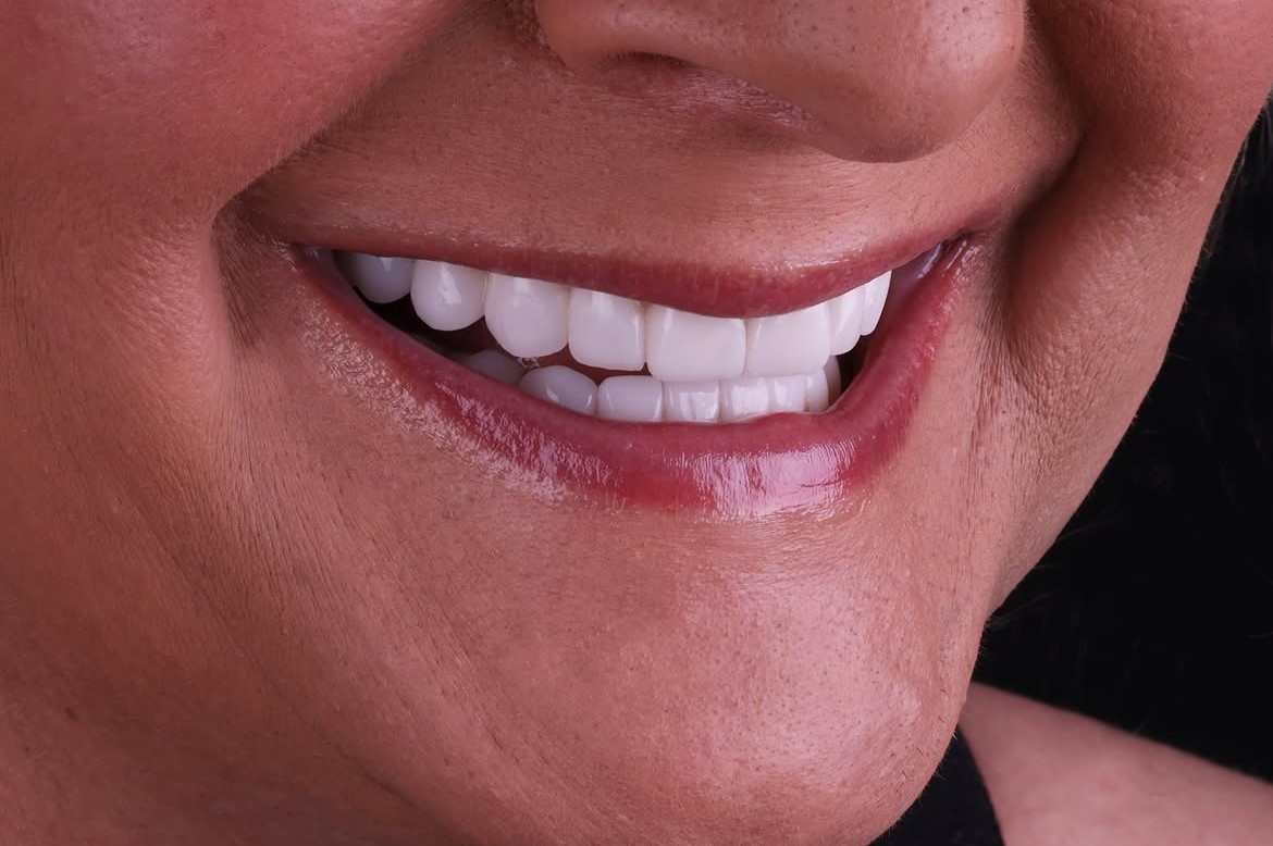Dental Crowns in Antalya, Turkey