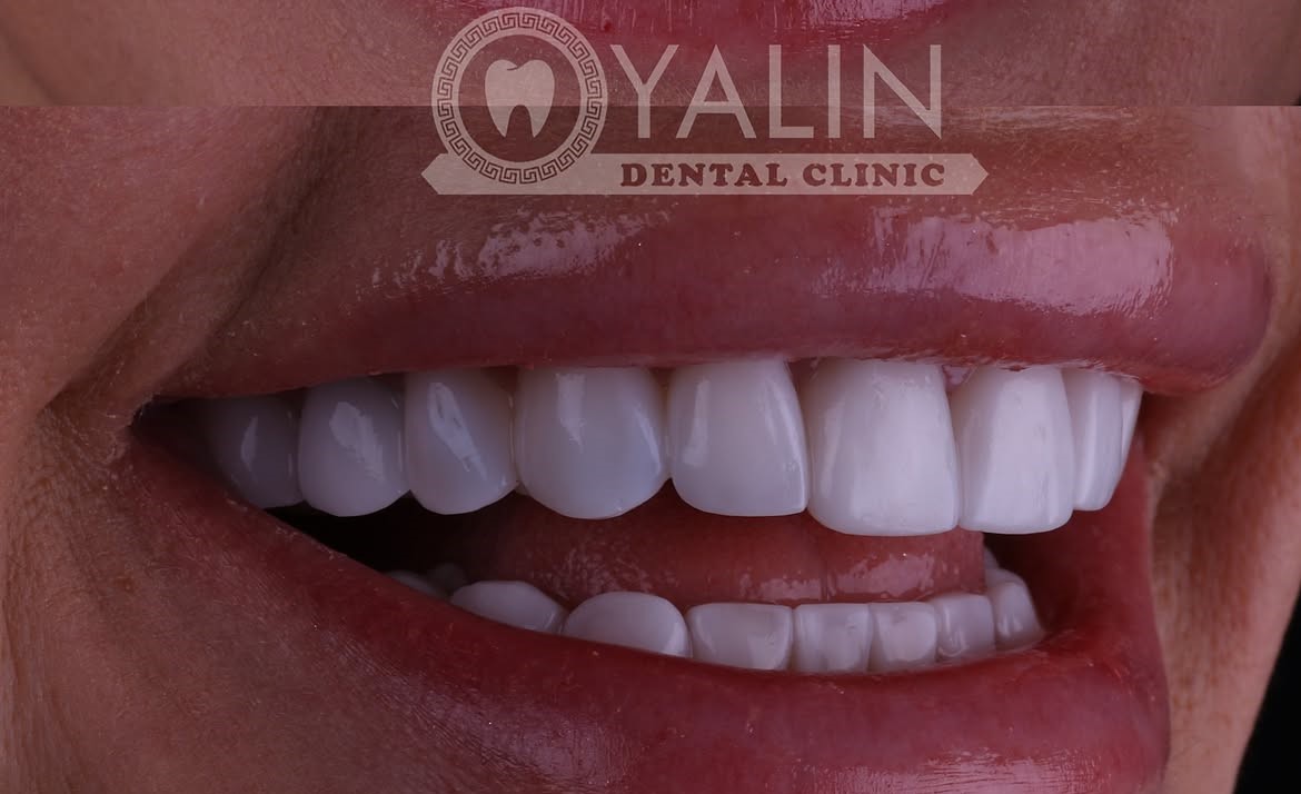 Dental Veneers in Antalya, Turkey