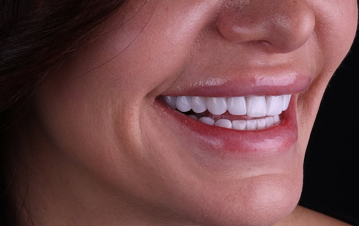 Dental Veneers in Antalya, Turkey