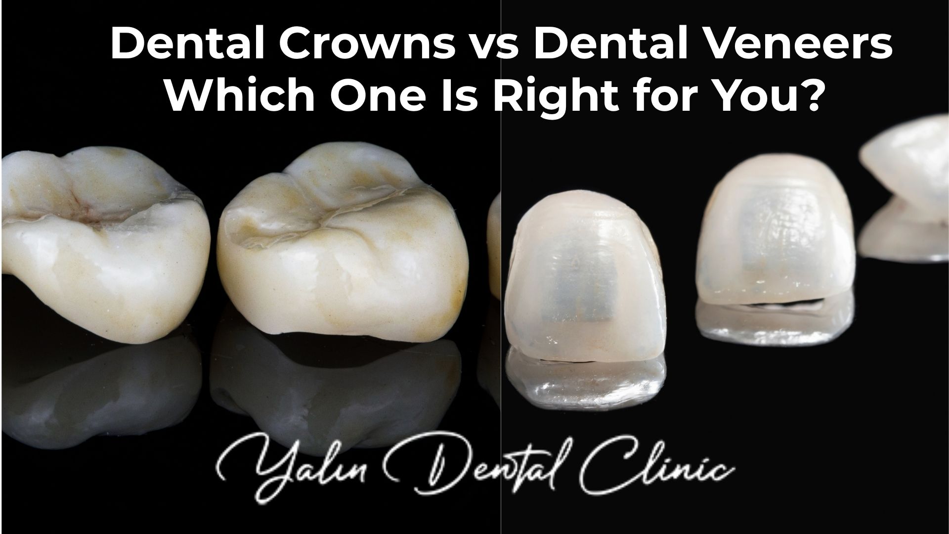 dental-crowns-vs-veneers
