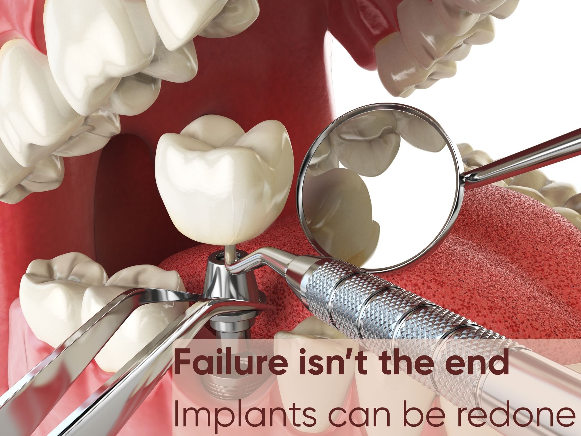 Can a failed dental implant be redone?