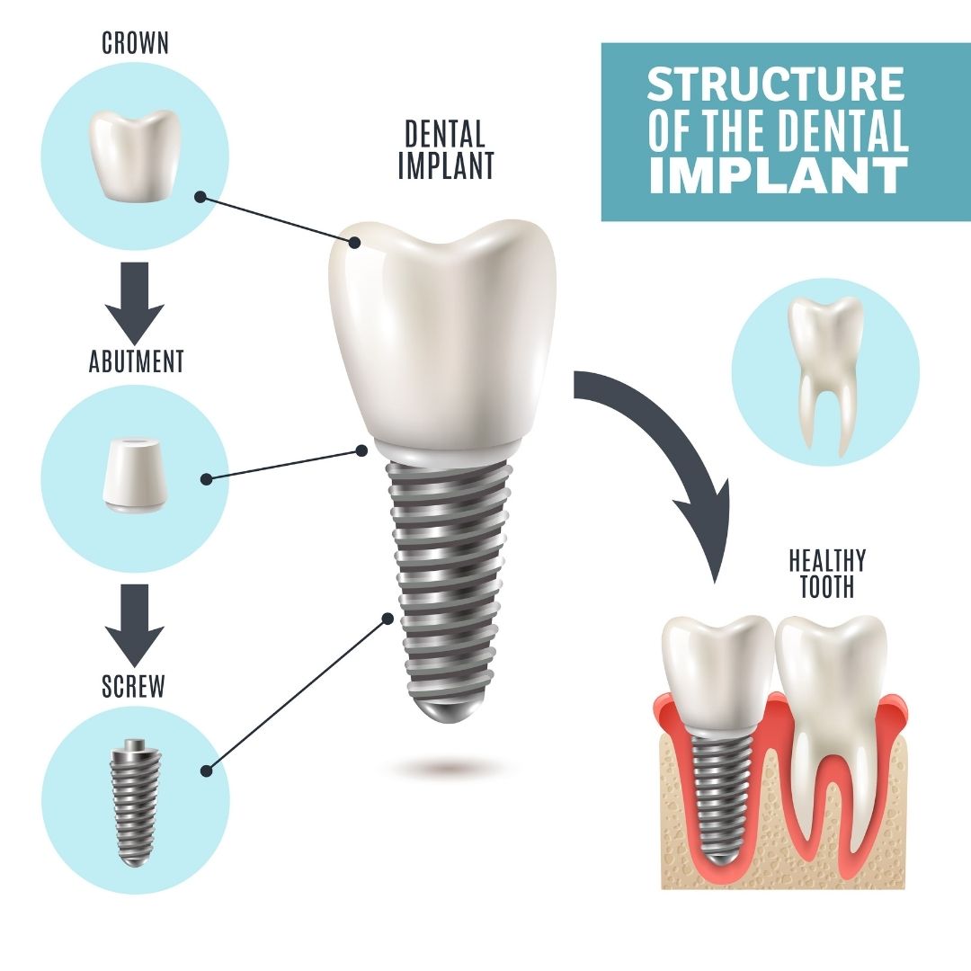 Structure of a dental implant