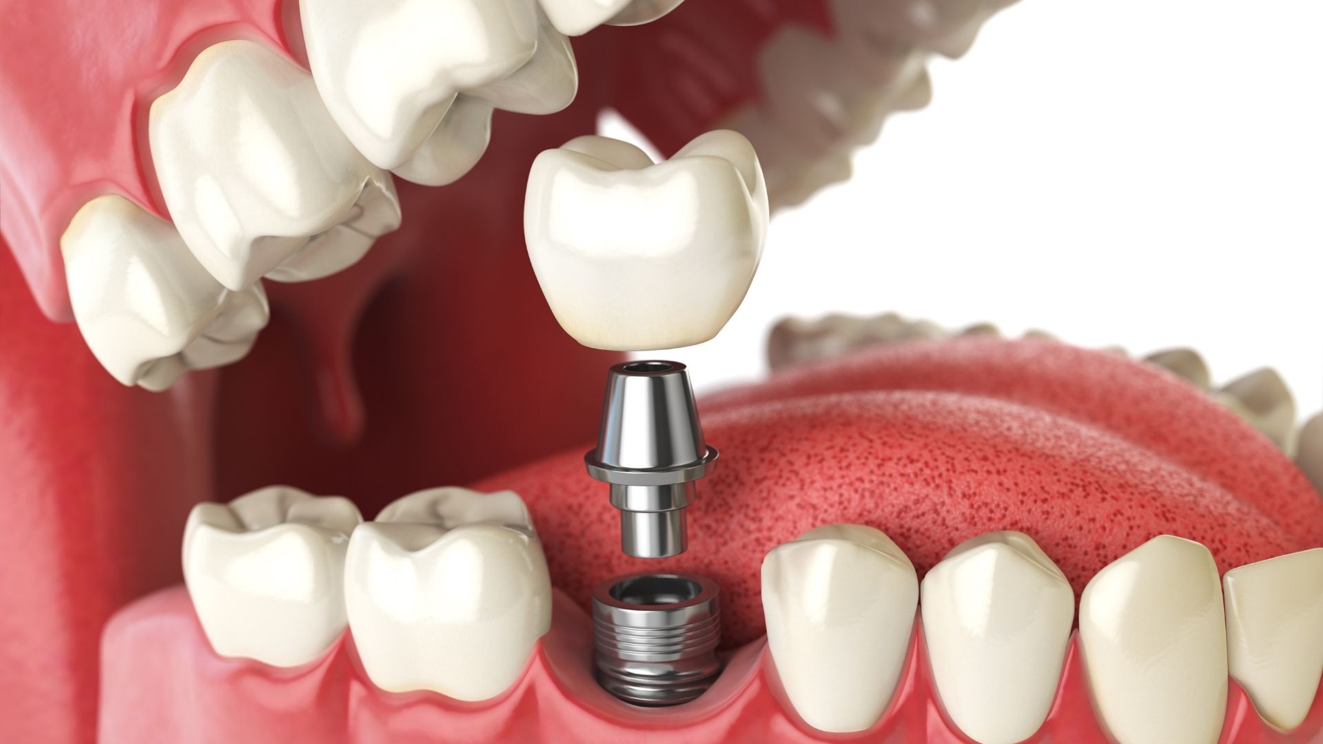 Dental Implants  in Turkey