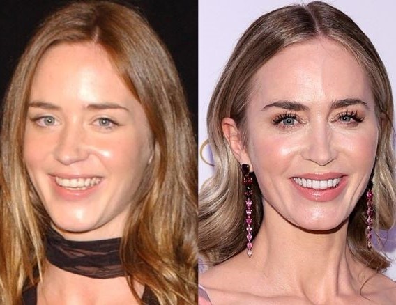 Emily Blunt’s Teeth before and after-1