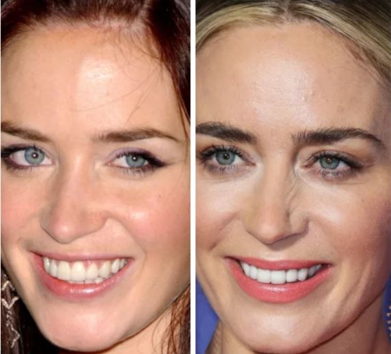 Emily Blunt’s Teeth before and after