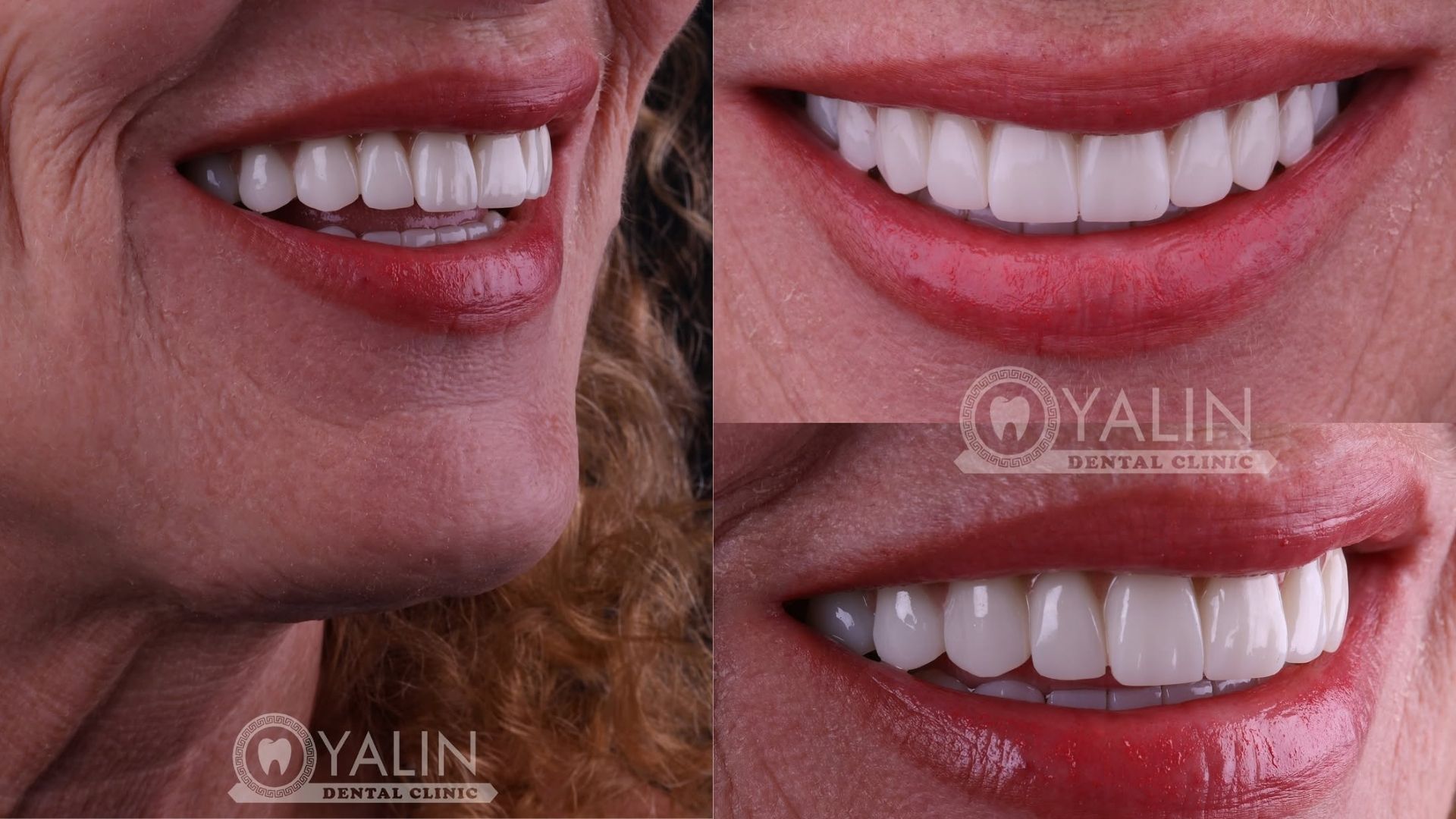 dental implant before and after