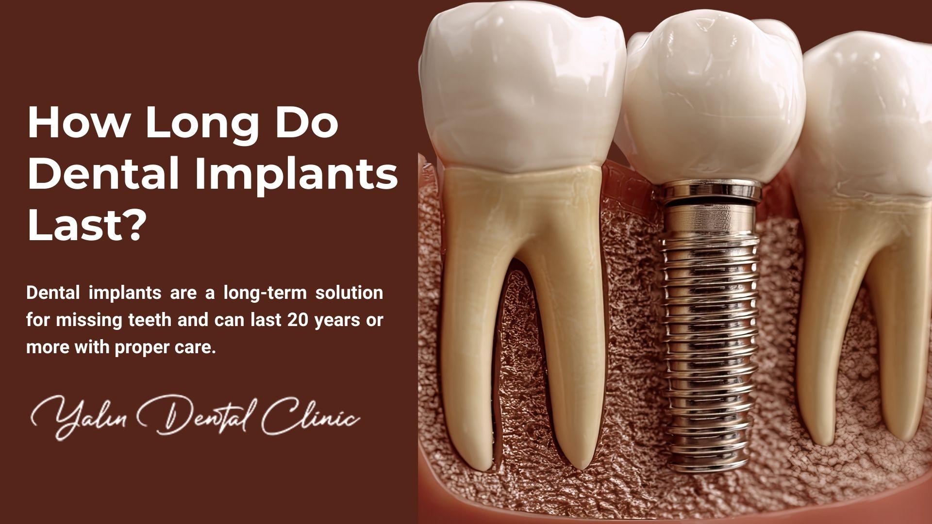 How Long Do Dental Implants Last? in Turkey, Antalya