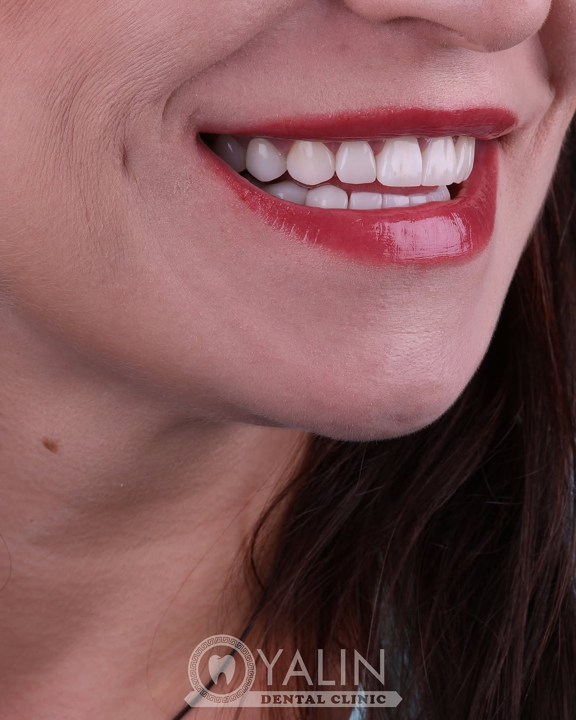 turkey-dental-veneers before and after-1 