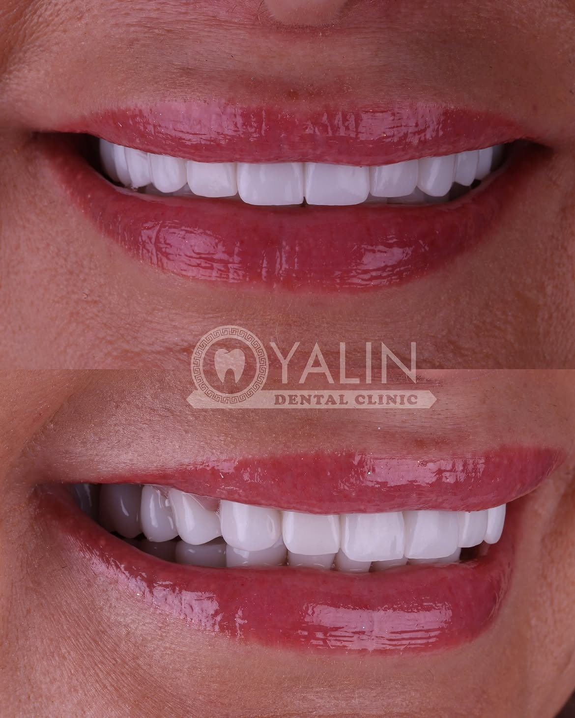 turkey-dental-veneers before and after-10 