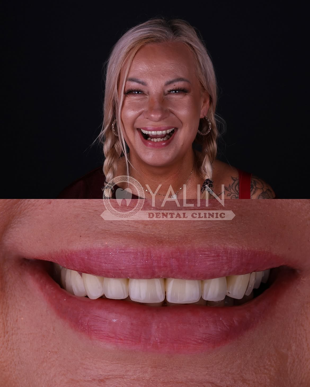 turkey-dental-veneers before and after-11 