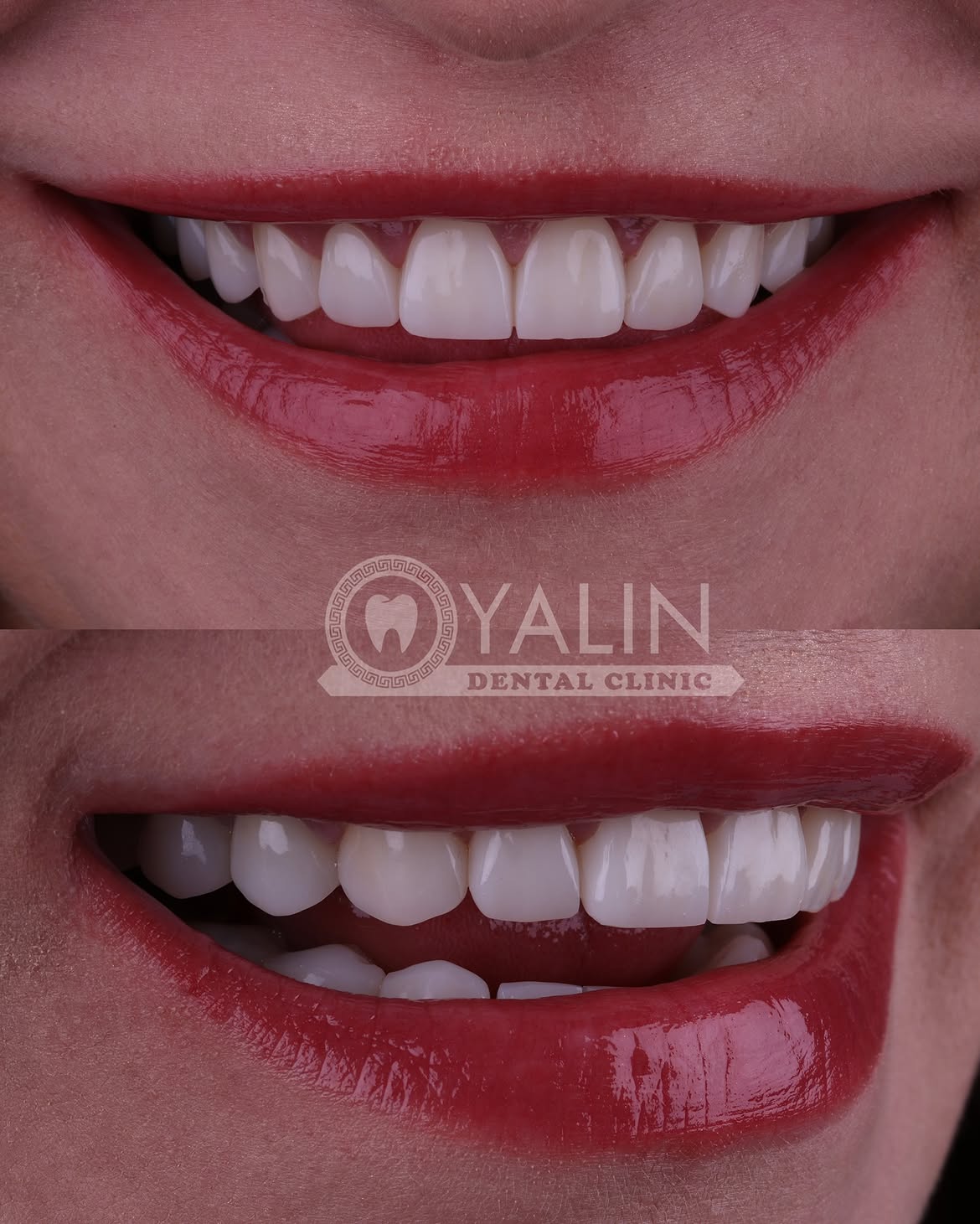 turkey-dental-veneers before and after-2 