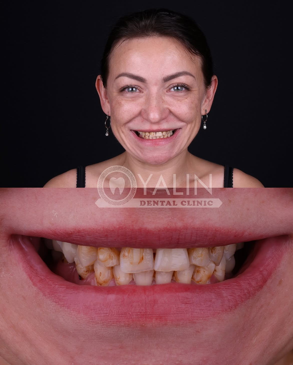 turkey-dental-veneers before and after-3 