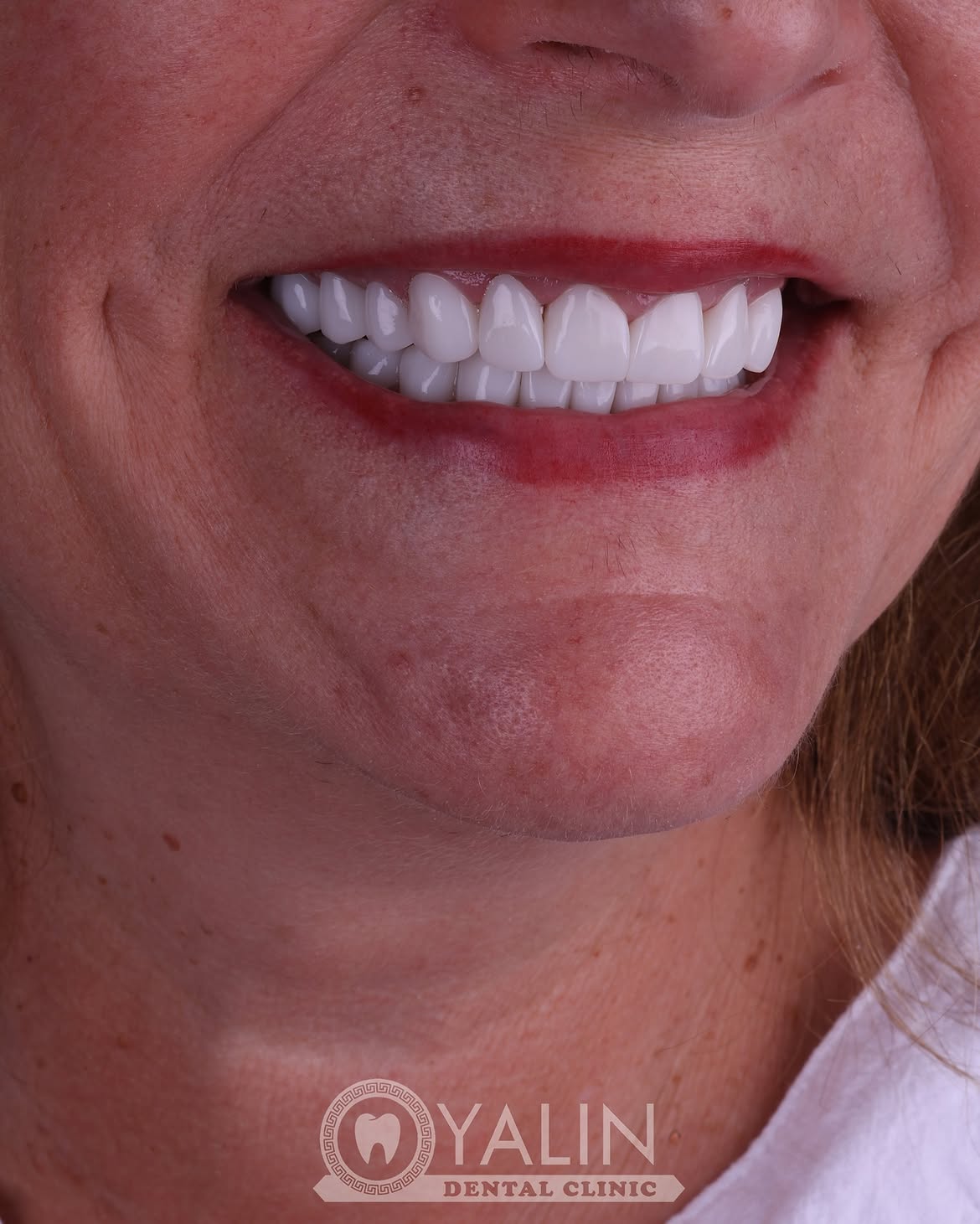 turkey-dental-veneers before and after-5 