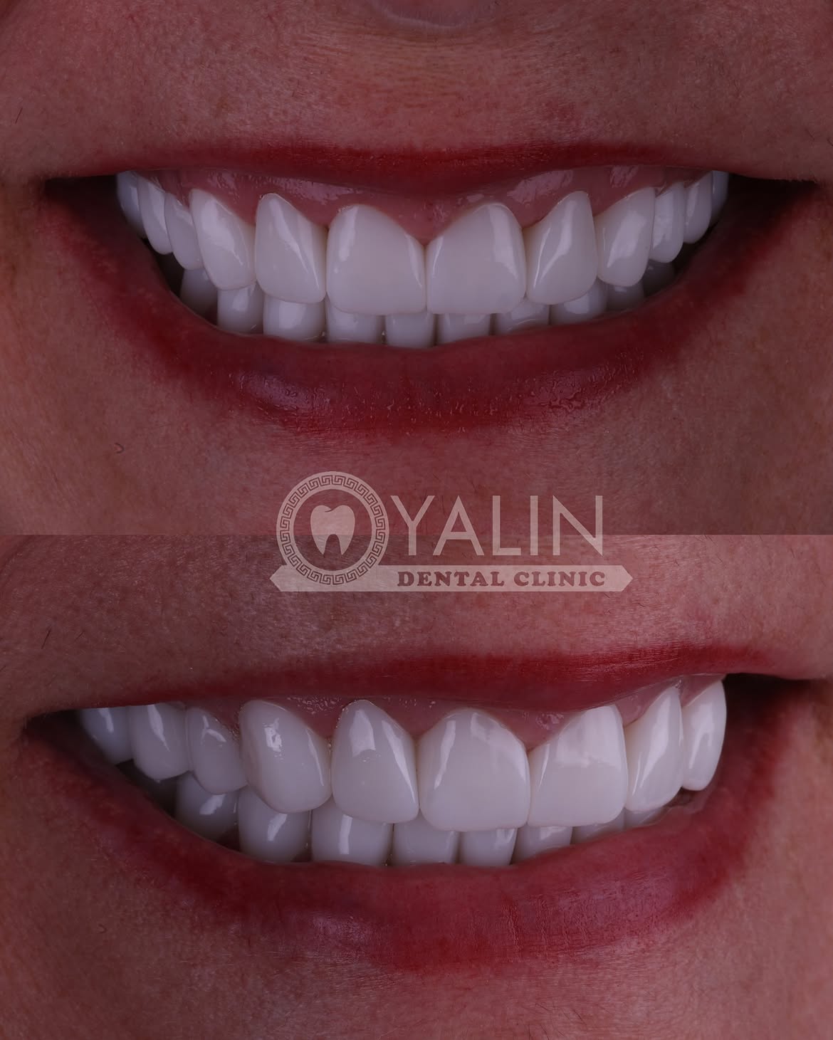 turkey-dental-veneers before and after-6 