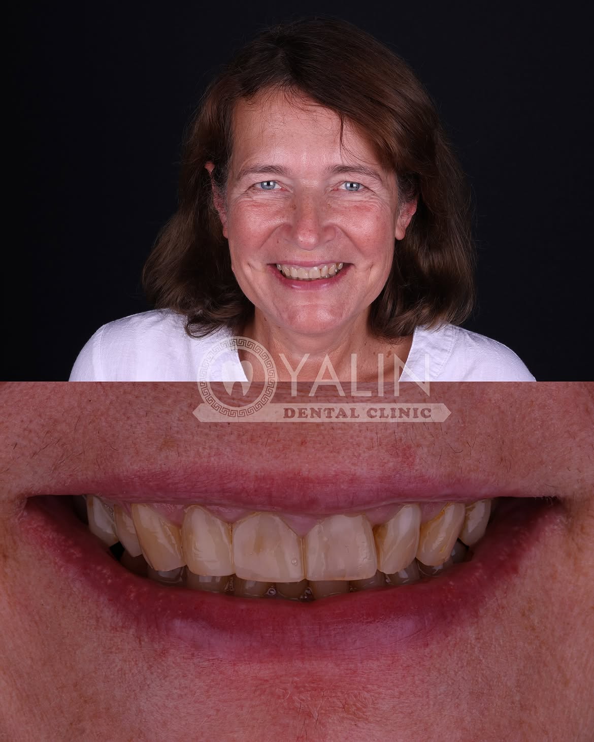 turkey-dental-veneers before and after-7 