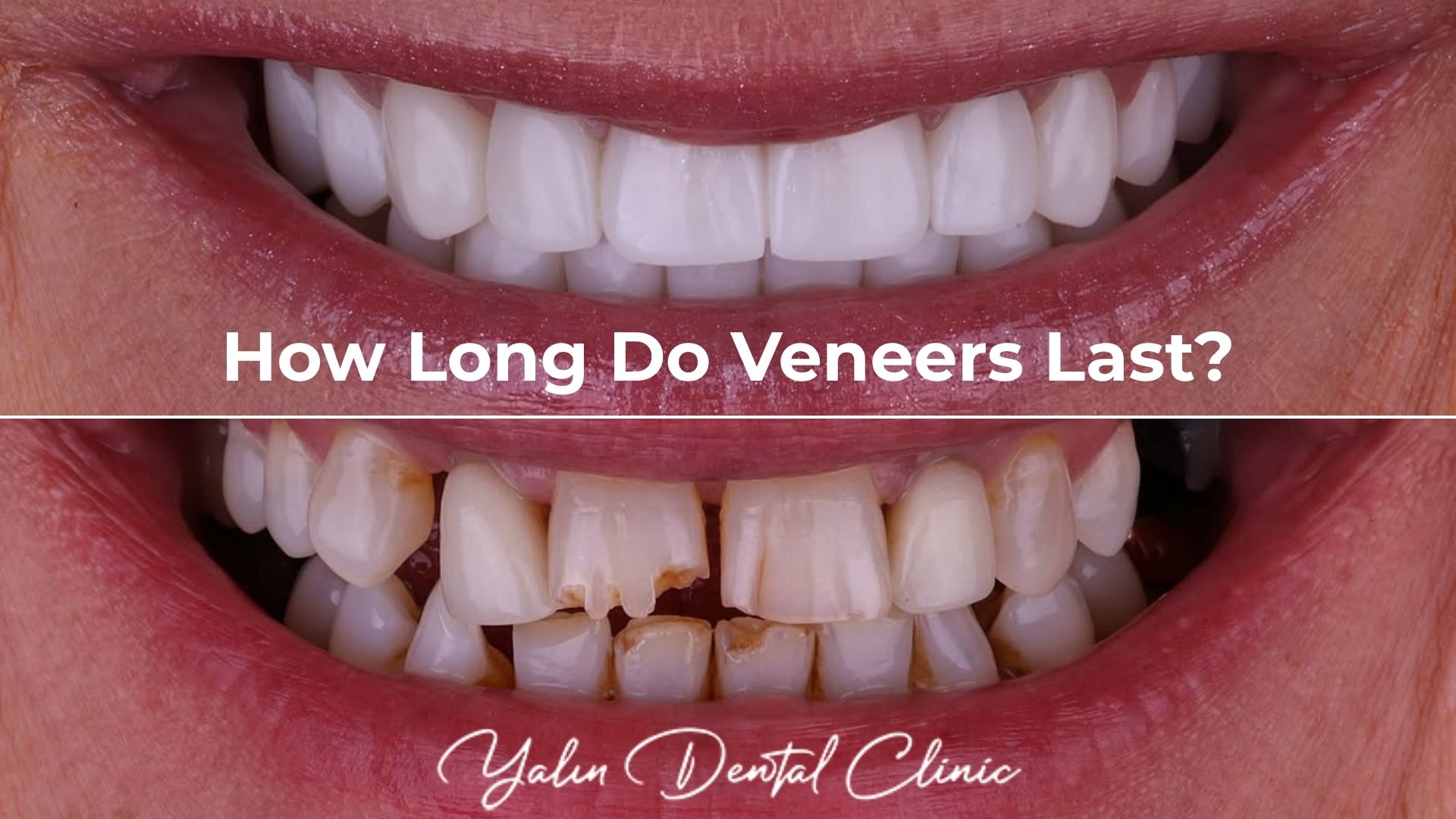 how-long-do-veneers-last-turkey-antalya?