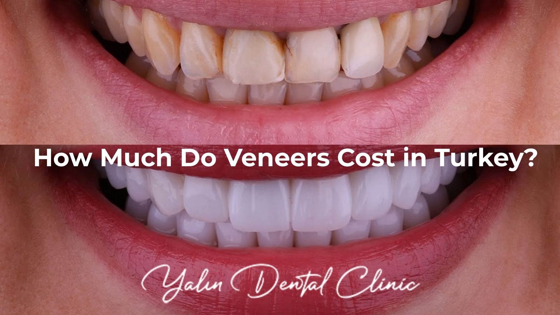 How much do veneers cost in Turkey, Antalya