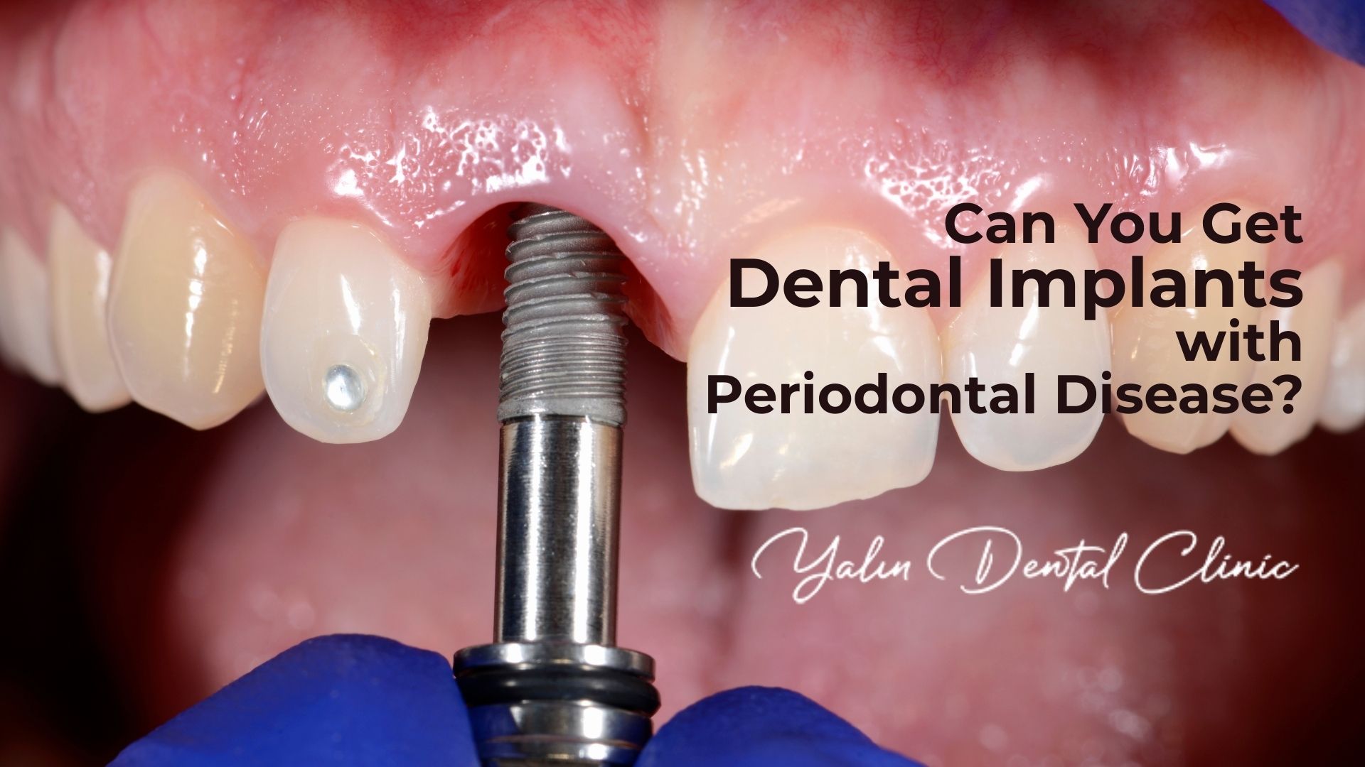 Can You Get Dental Implants with Periodontal Disease?