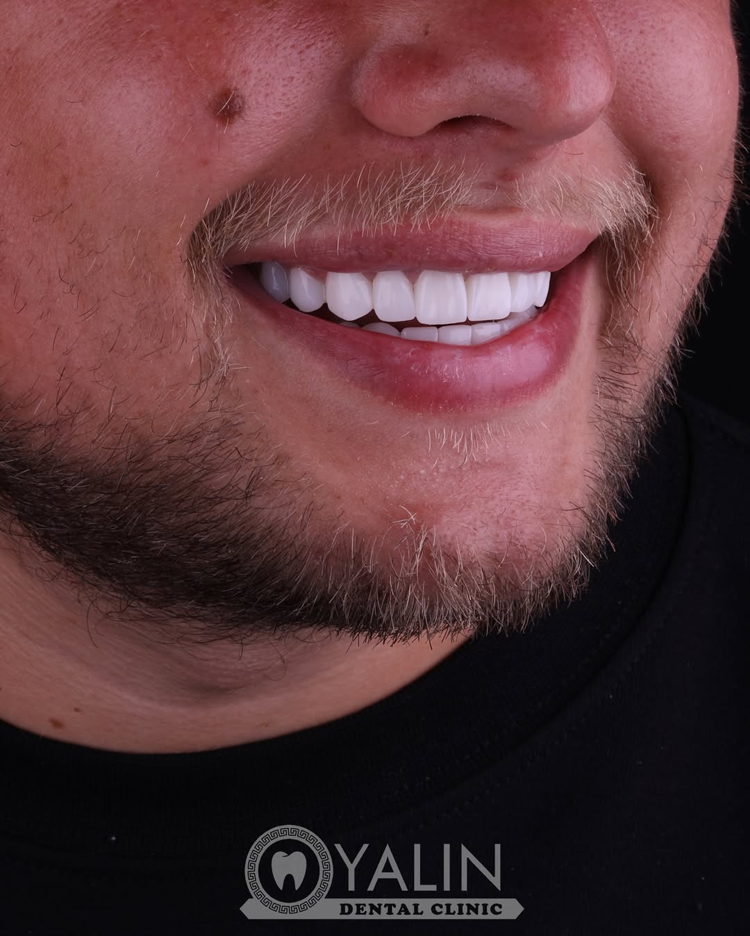 dental treatments before and after-14