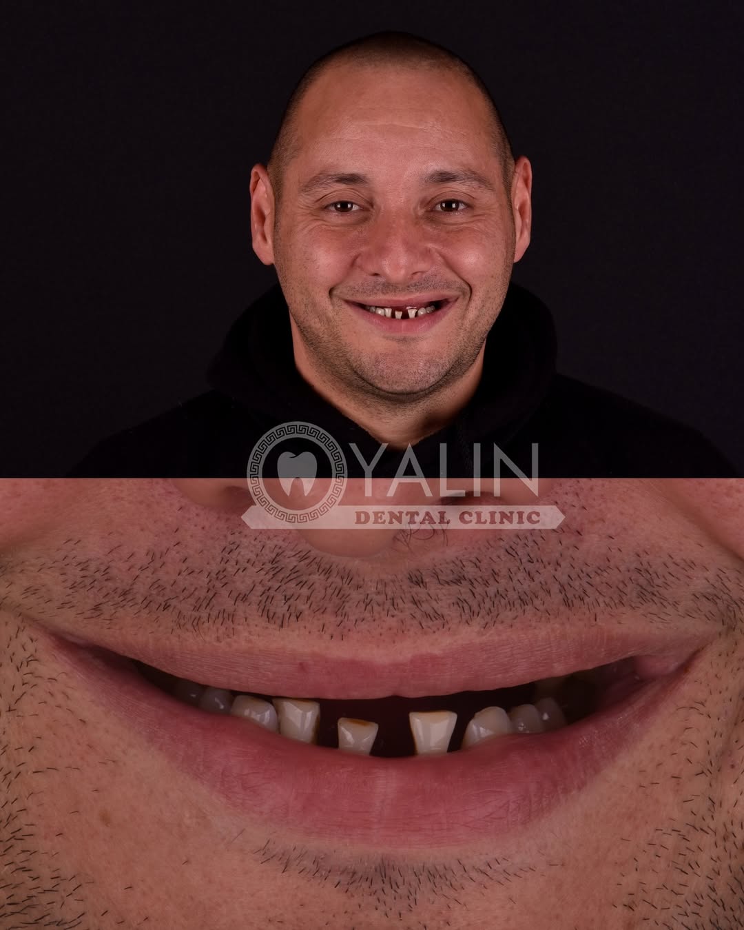 dental treatments before and after-4