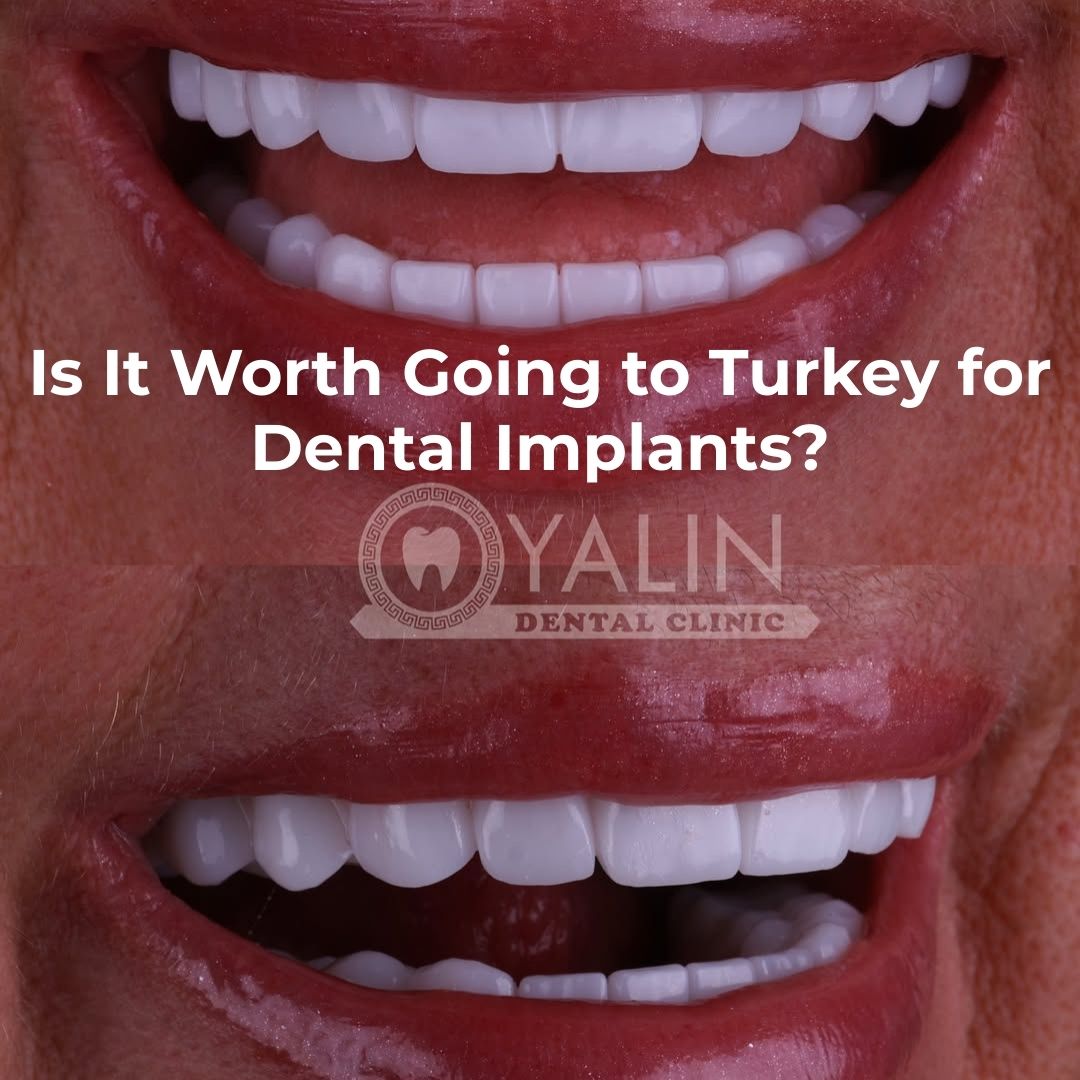 Is It Worth Going to Turkey for Dental Implants?