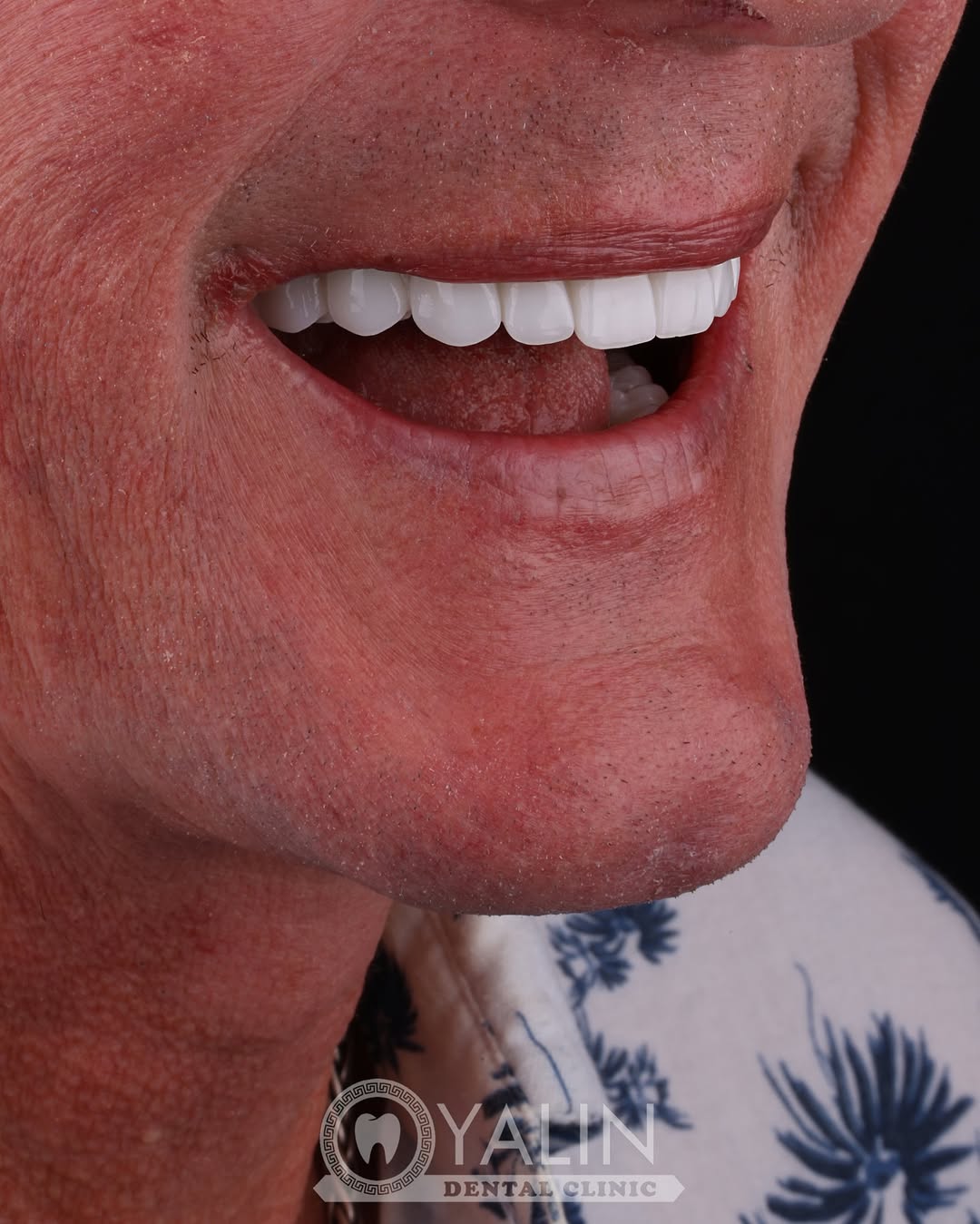 dental-treatment-in-turkey-4