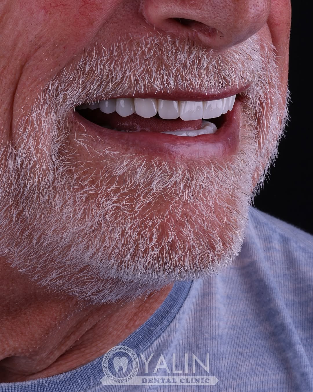 dental-treatment-in-turkey-5