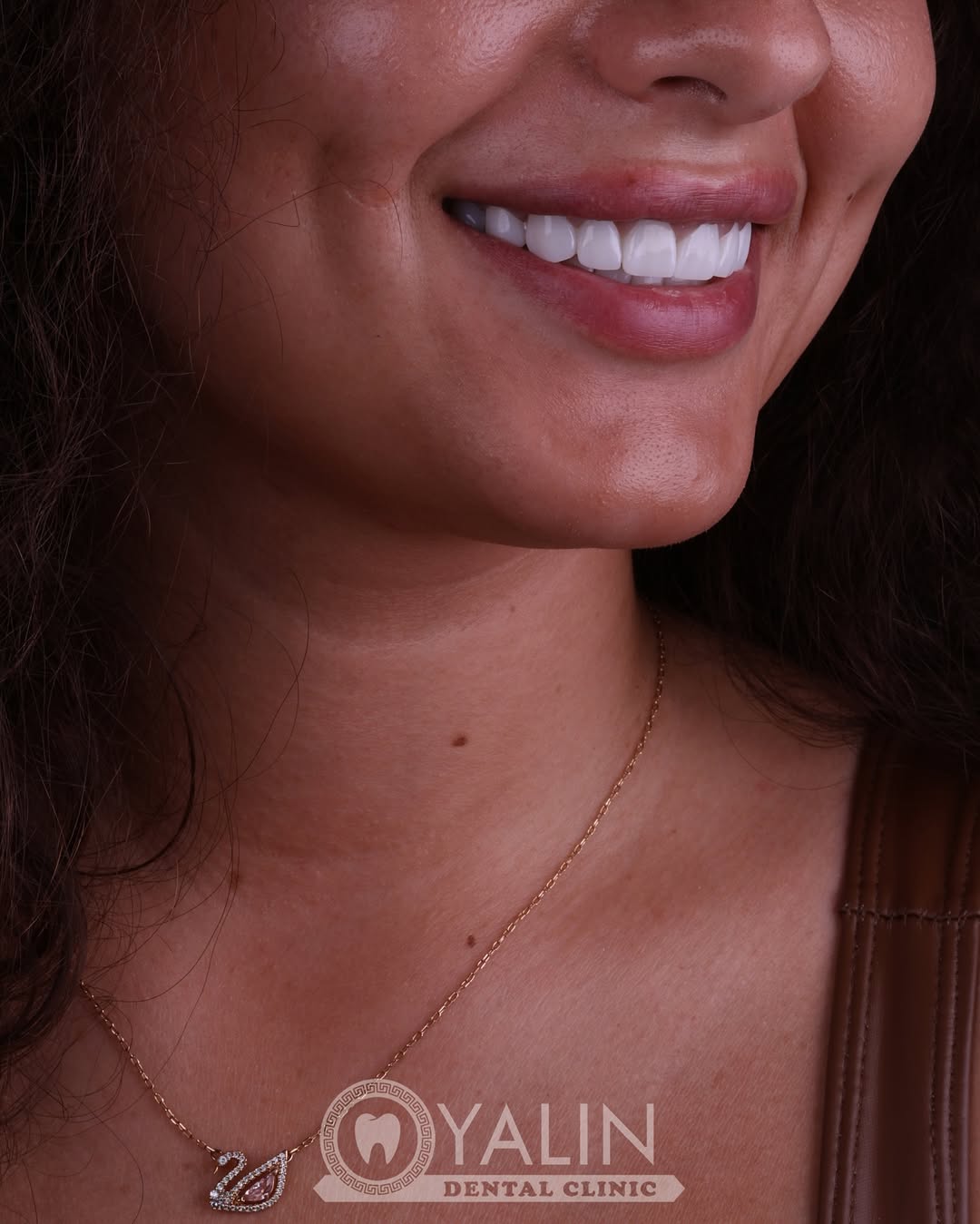 dental-treatment-in-turkey-7