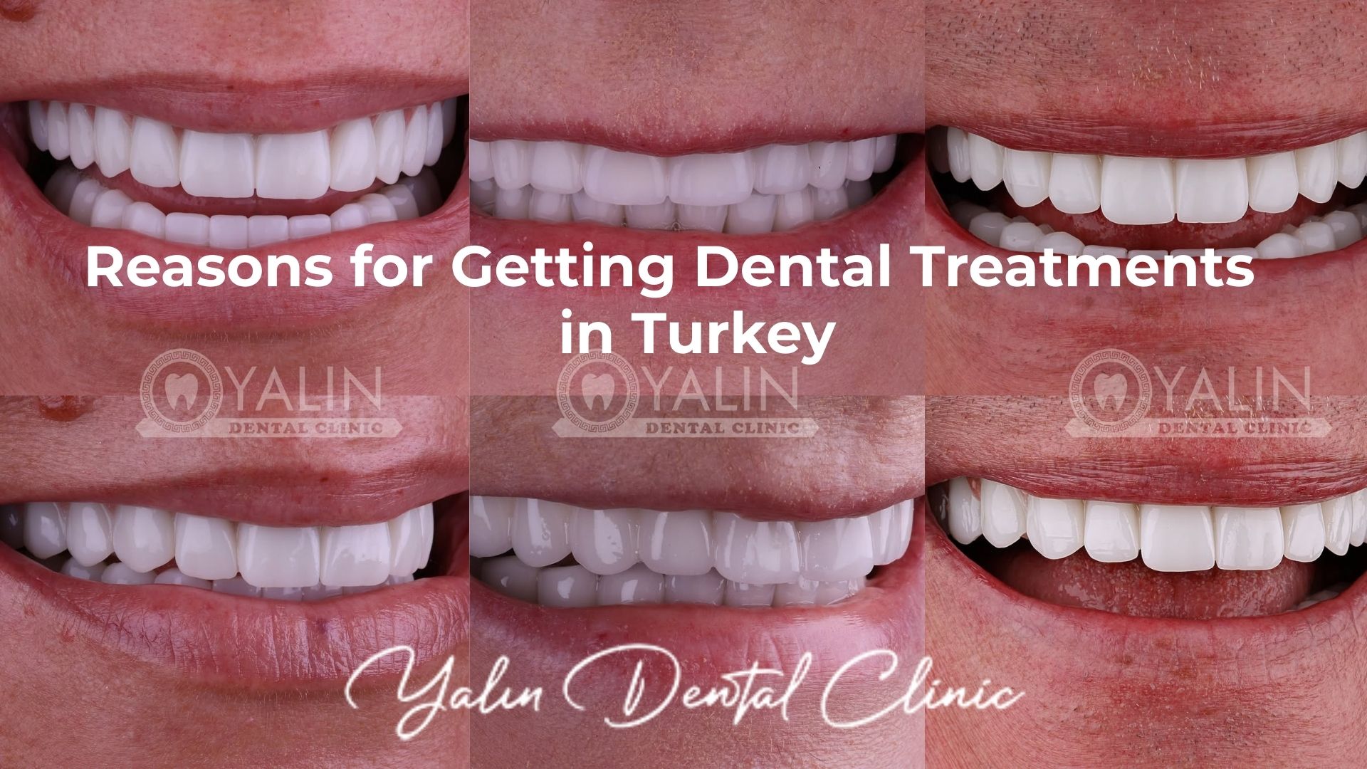 Reasons for Getting Dental Treatment in Turkey