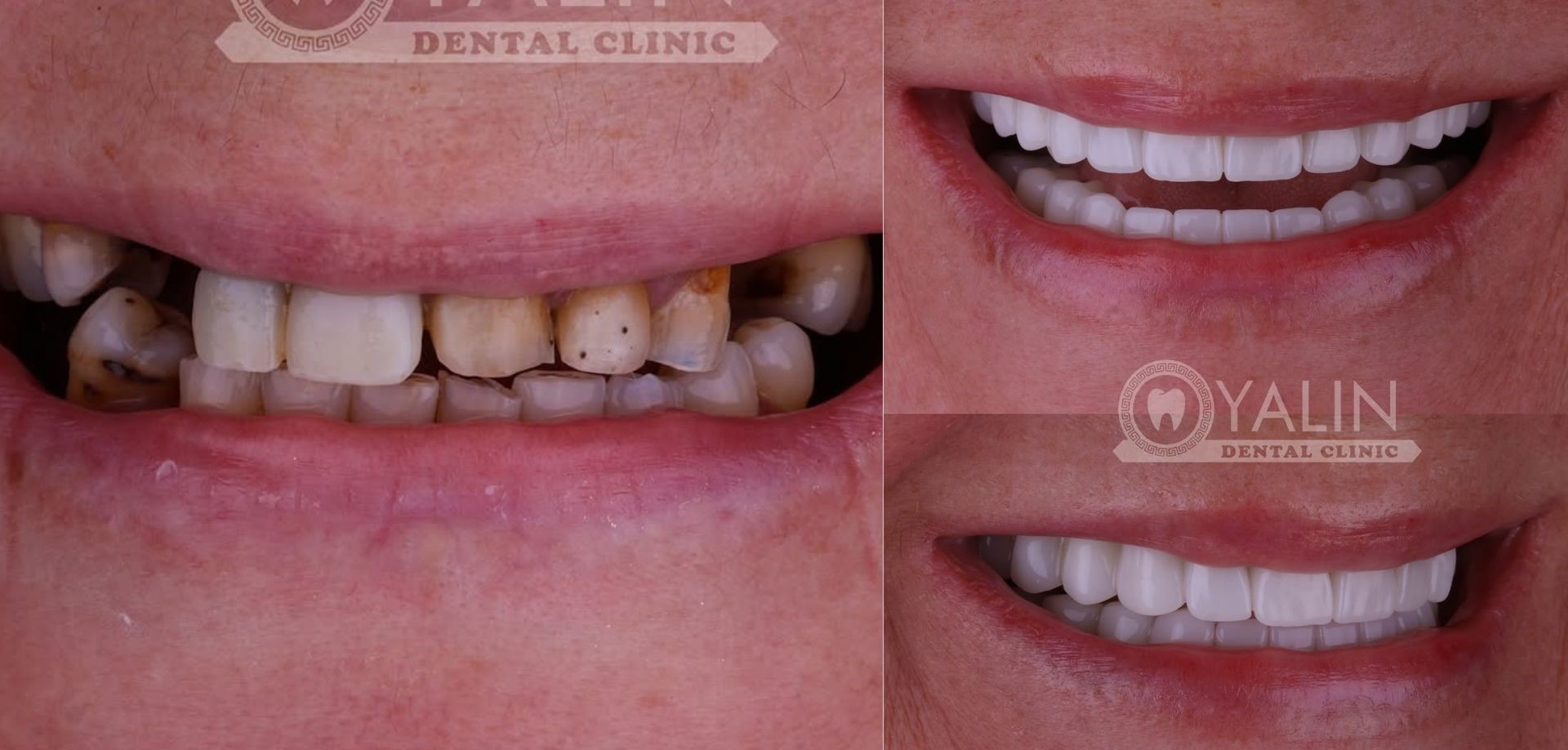Dental Implants 