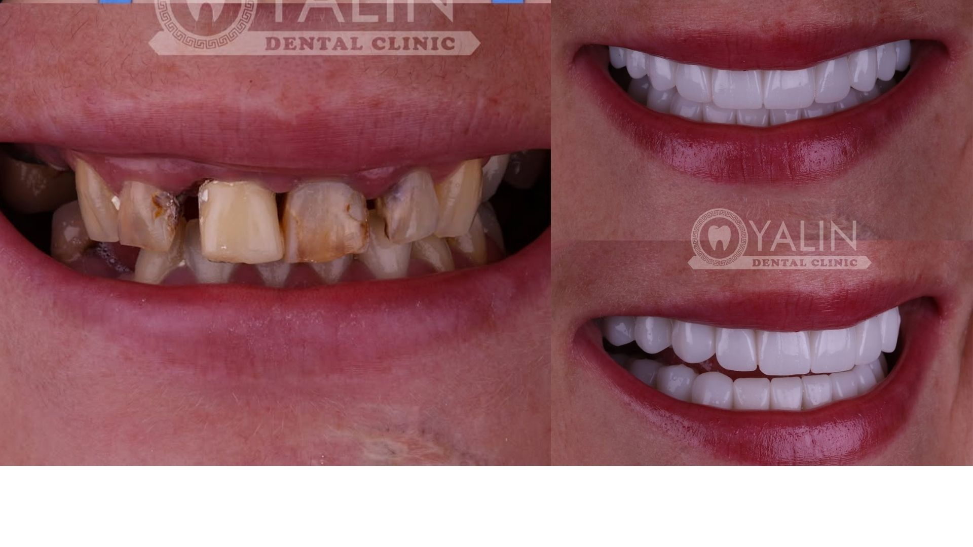 Dental Implants in Turkey, Antalya 