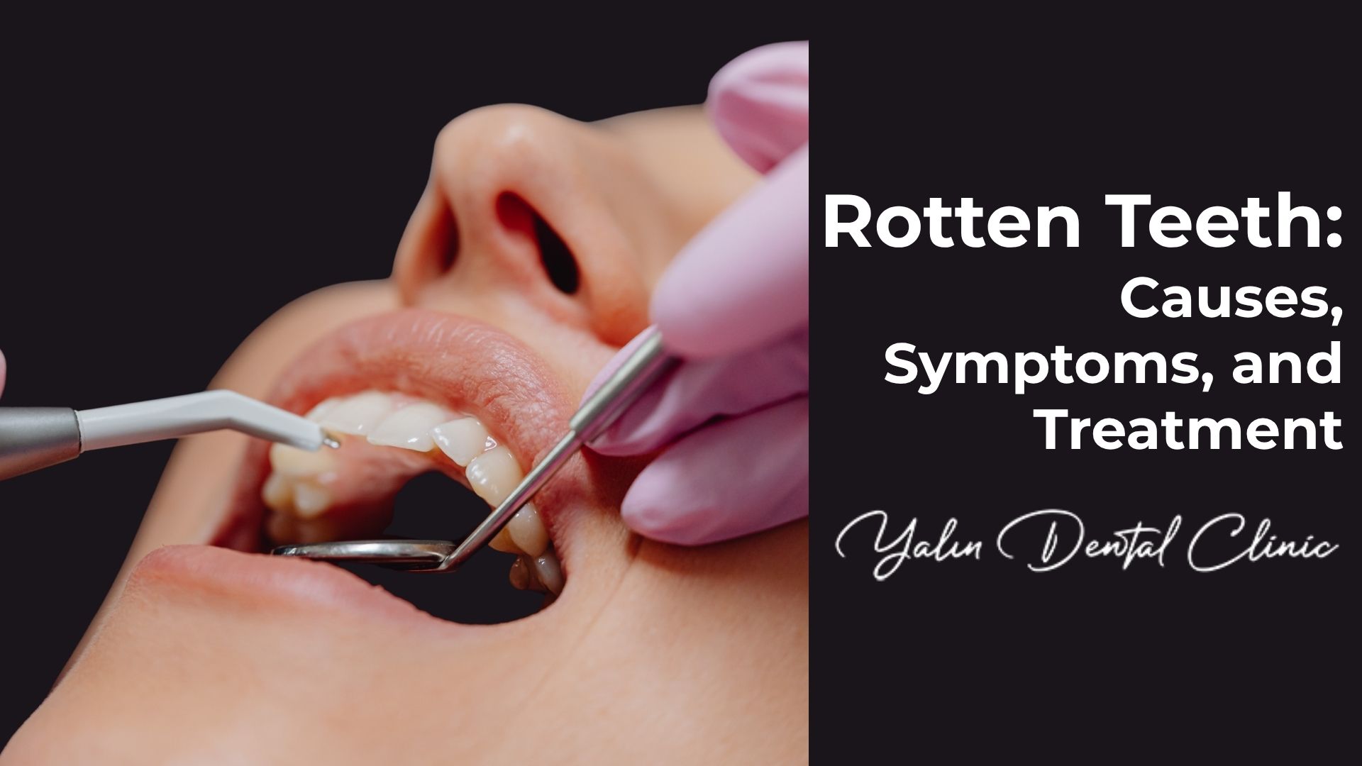 Rotten Teeth/Tooth decay: Symptoms & Treatment