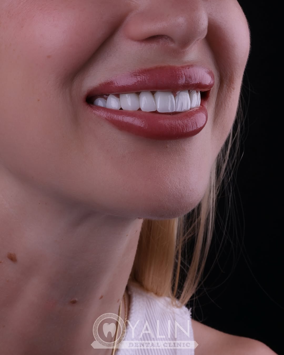 Dental Veneers at Yalın Dental Clinic