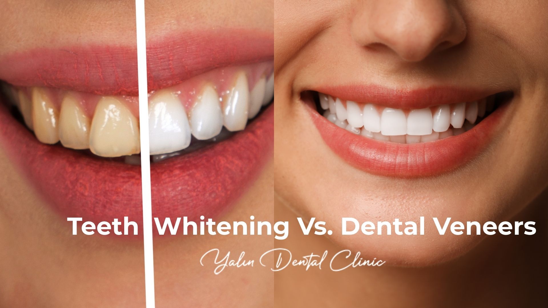 teeth-whitening-vs-veneers