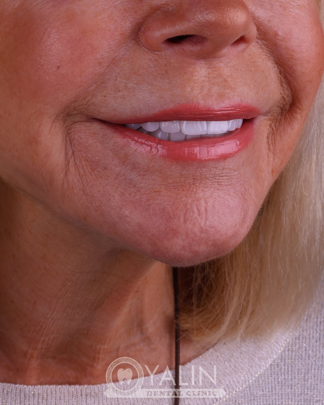 turkey-teeth-veneers before and after-12 