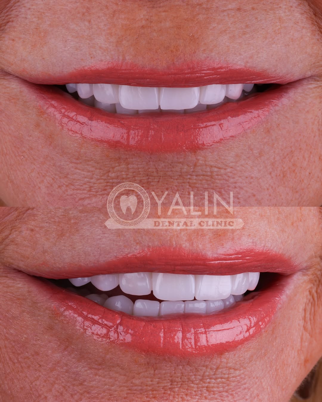 turkey-teeth-veneers before and after-13 