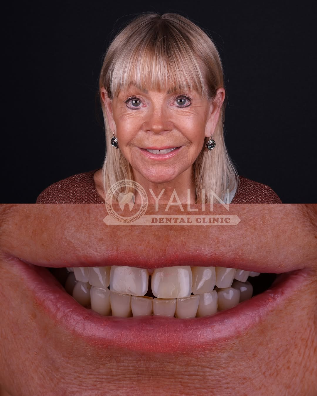 turkey-teeth-veneers before and after-14 