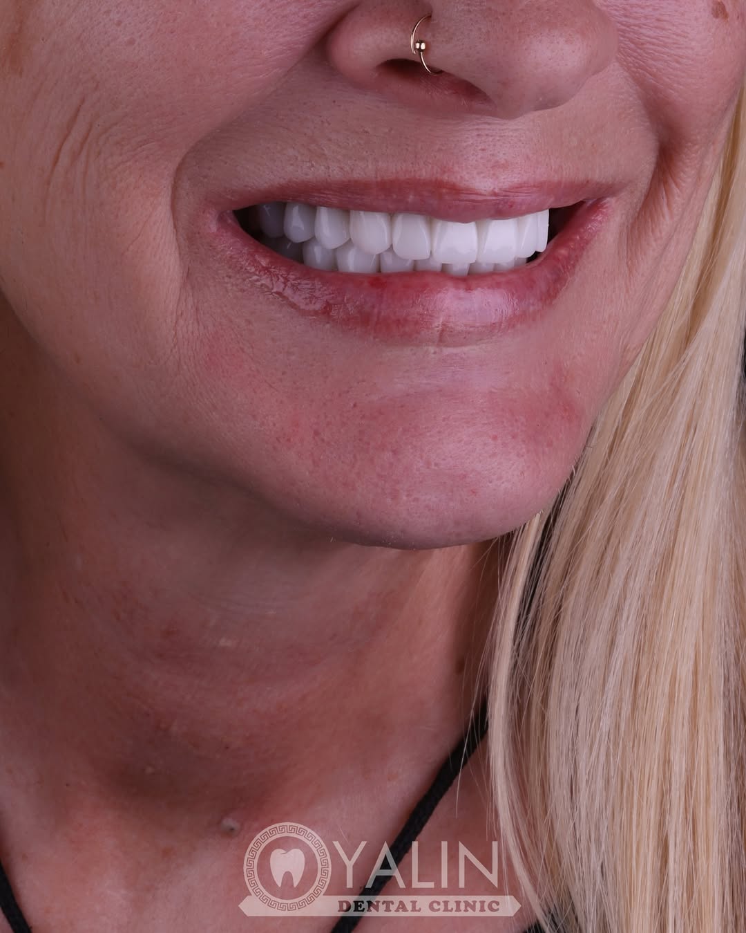 turkey-teeth-veneers before and after-17 
