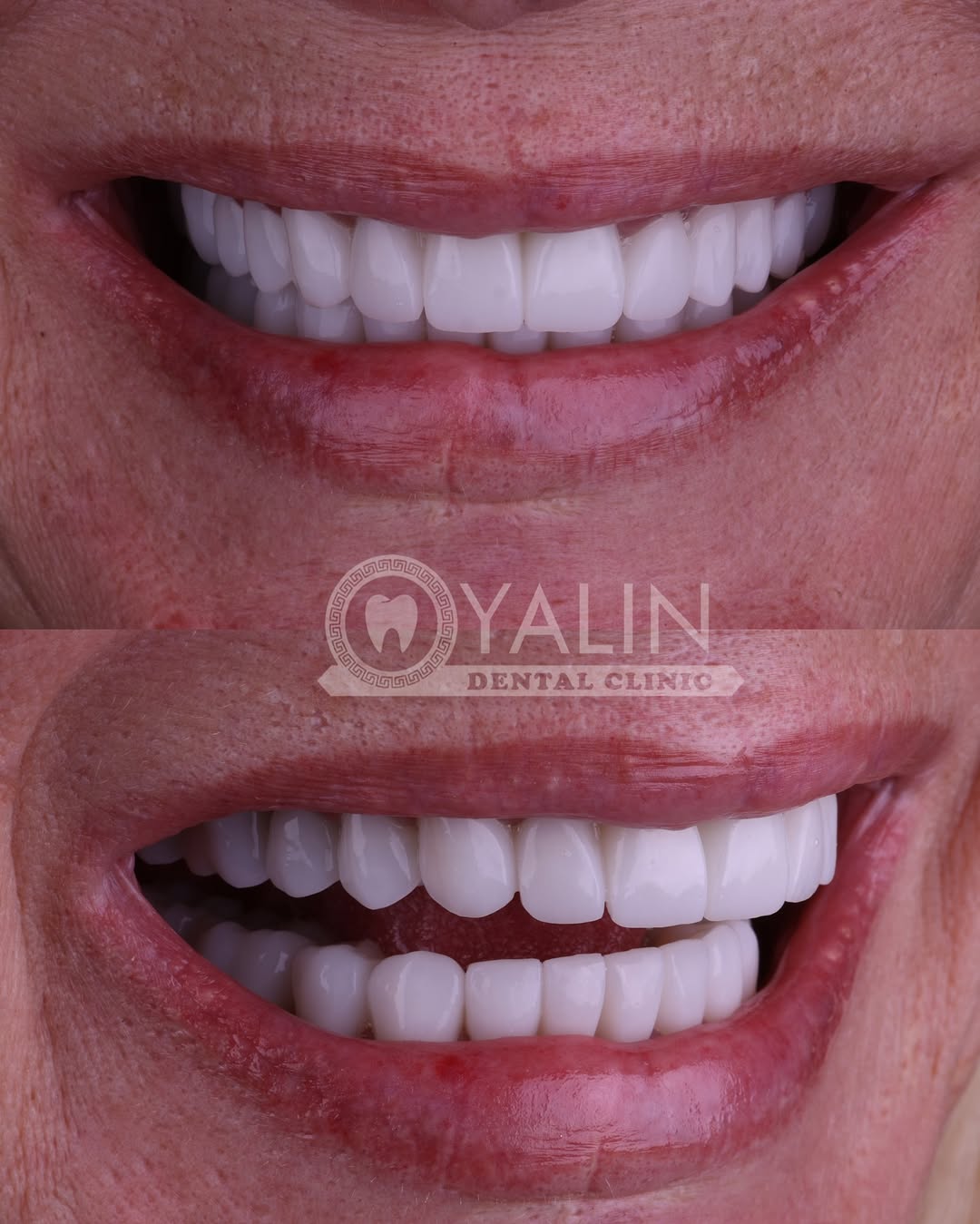 turkey-teeth-veneers before and after-18 